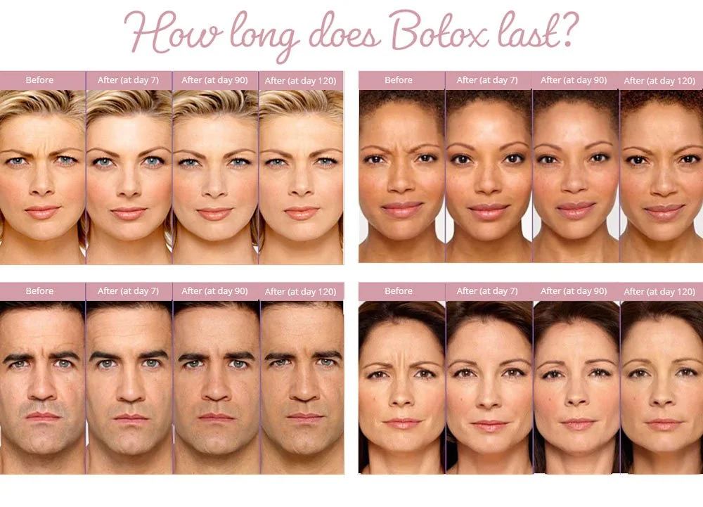 How Long Does Botox Last? A Dermatologist’s Complete Breakdown